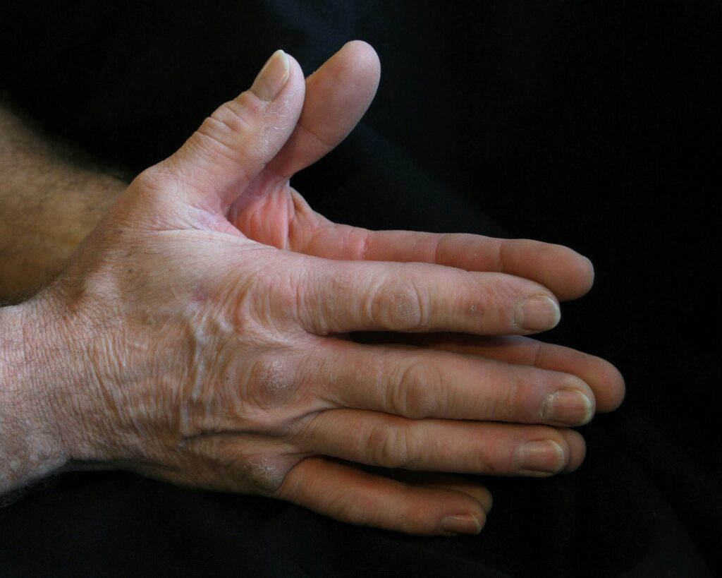 douleur aux mains